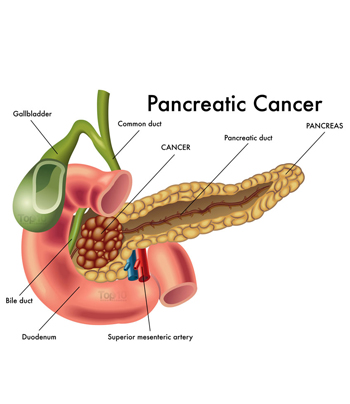 Pancreatic Cancer Specialist In UAE