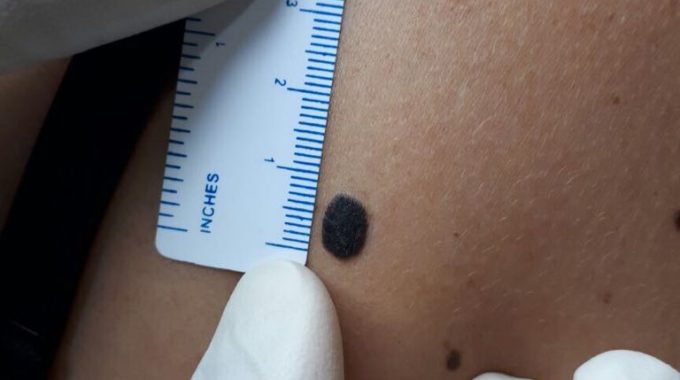 Our superb team in melanoma approach and sentinel lymph node excision at alzahra cancer center in our tertiary referral center is the icon of azhd in the heart of Dubai