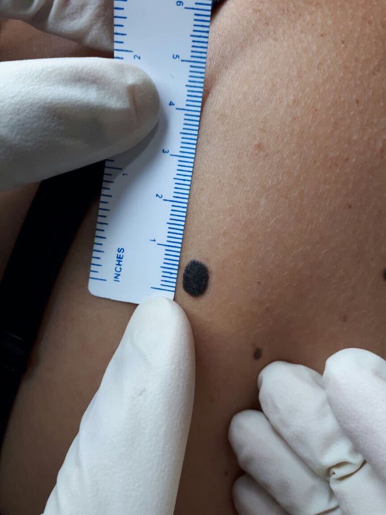 Our superb team in melanoma approach and sentinel lymph node excision at alzahra cancer center in our tertiary referral center is the icon of azhd in the heart of Dubai