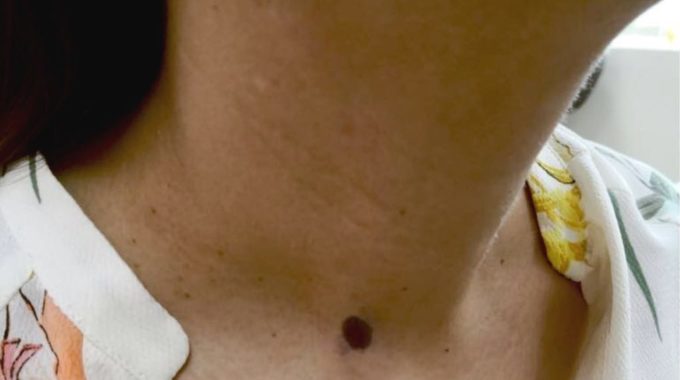 Parathyroid Surgery in Dubai, UAE