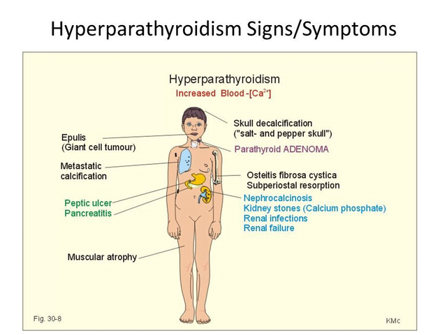 hypoparathyroidism signs and symptoms