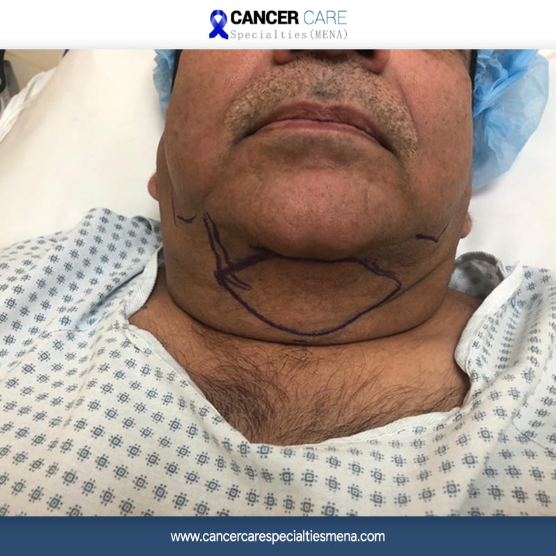 Tongue Cancer With Reconstruction Surgery In Alzahra Cancer Center Cancer Care Center Uae 2782