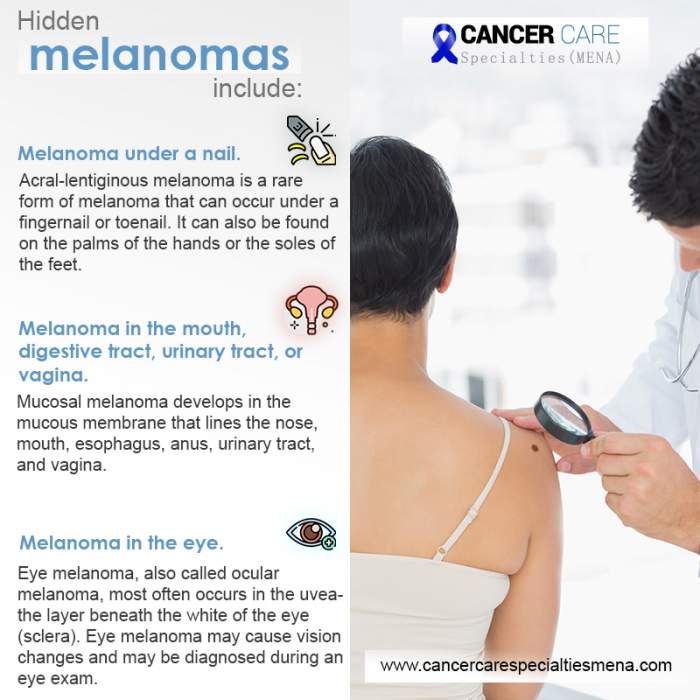 Hidden Melanomas can be found?