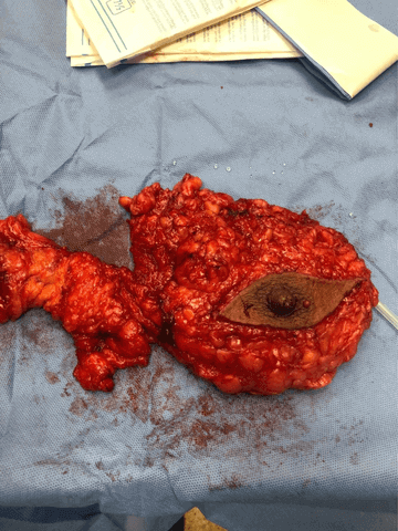 Modified Radical mastectomy at one of satellites of AlzahraDubai in Covid Era in MENA