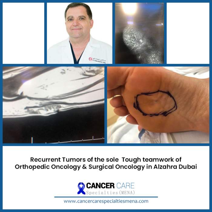 Recurrent Tumors of the sole Tough team work of Orthopedic Oncology & Surgical Oncology in Alzahra Dubai