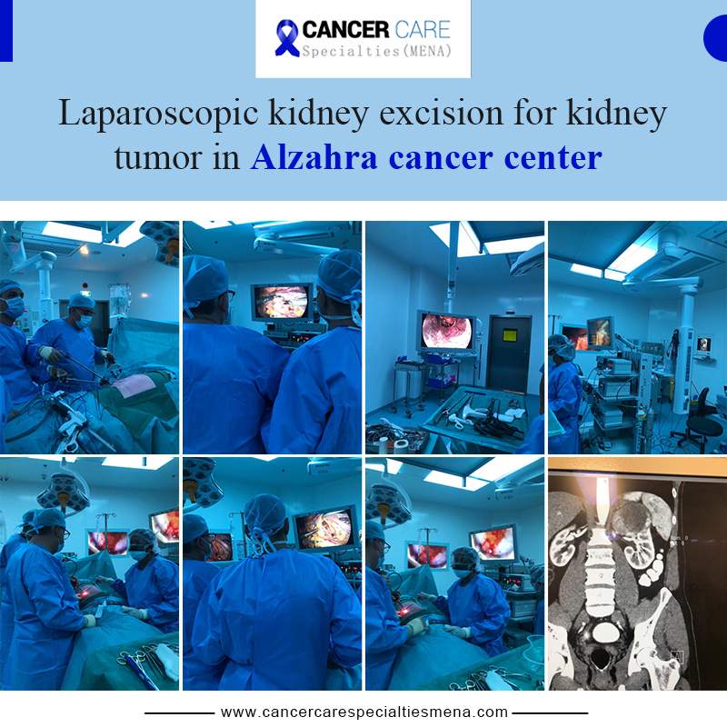 Laparoscopic kidney excision for kidney tumor in Alzahra cancer center.