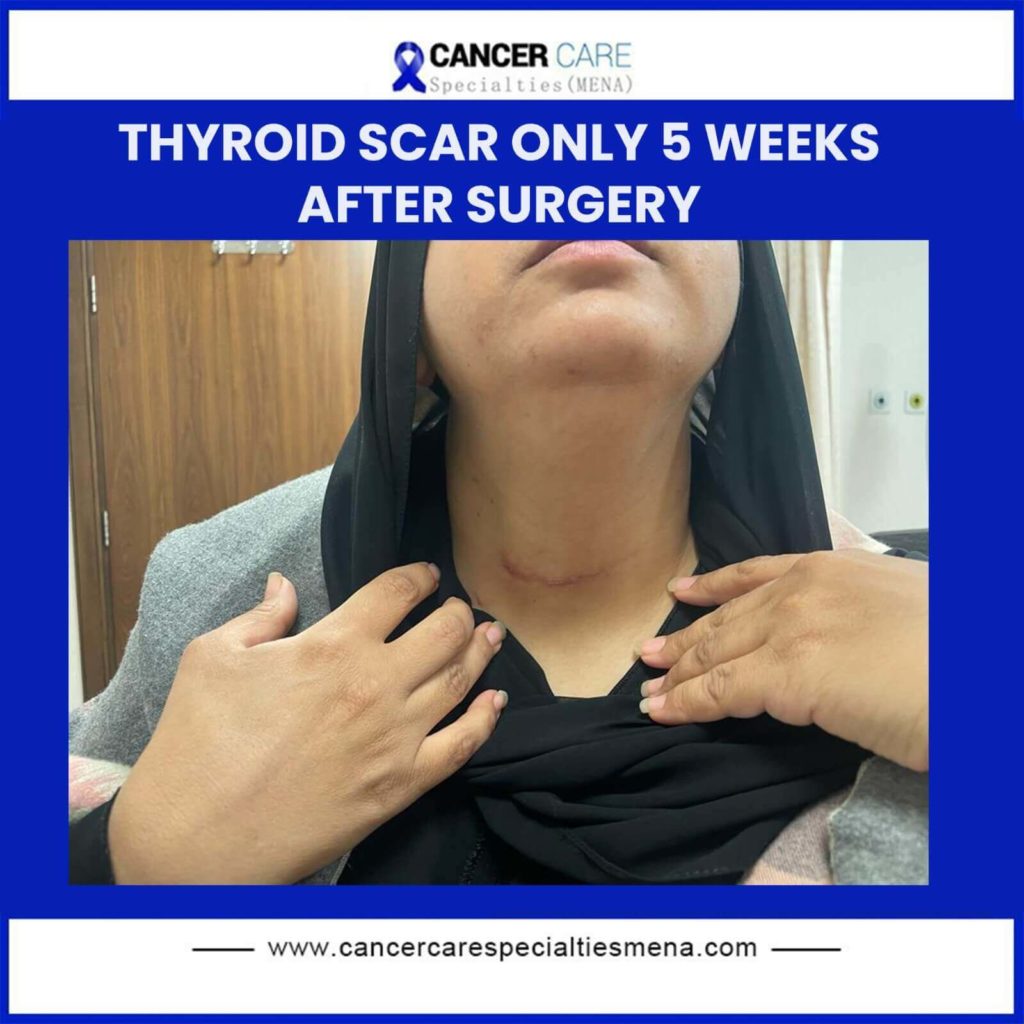 thyroid-scar-only-5-weeks-after-surgery-cancer-care-center-uae