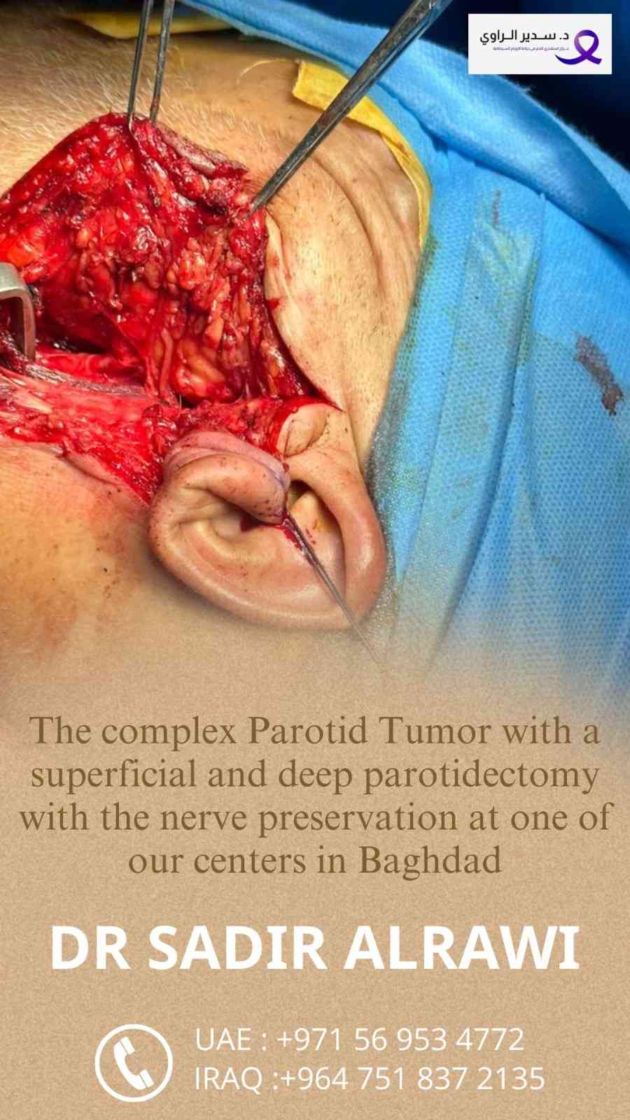 Parotid Surgery Post