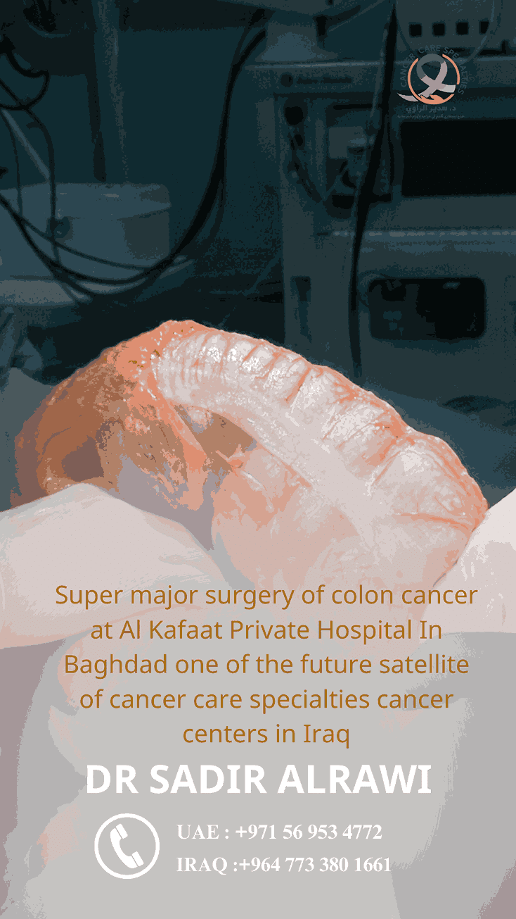 Colon cancer surgery